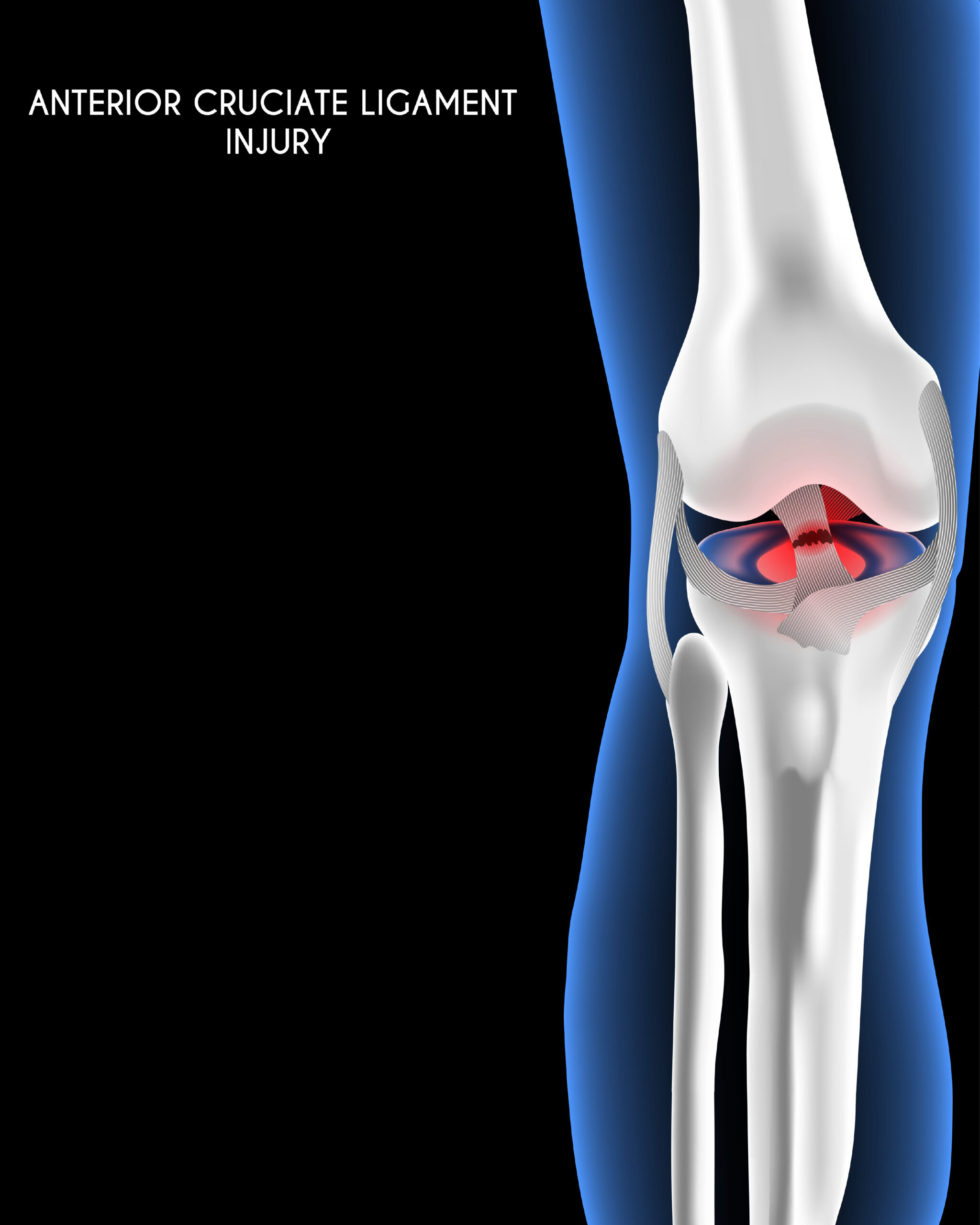 Medical orthopedic abstract background. Treatment for orthopedics traumatology of knee bones and joints injury and ACL injury. Medical presentation, hospital. Vector illustration
